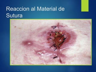 Reaccion al Material de
Sutura
 