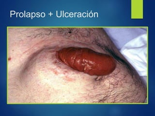 Prolapso + Ulceración
 