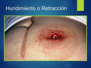 Hundimiento o Retracción
 