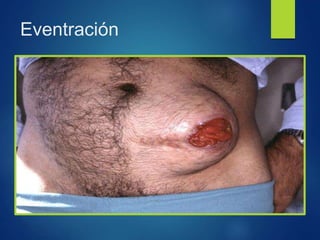 Eventración
 