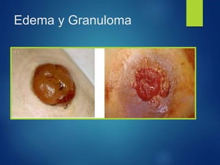 Edema y Granuloma
 