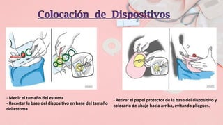 - Medir el tamaño del estoma
- Recortar la base del dispositivo en base del tamaño
del estoma
- Retirar el papel protector de la base del dispositivo y
colocarlo de abajo hacia arriba, evitando pliegues.
 