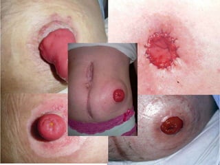 Exemplos de Indicações
Fístulas reto-vaginais;
Perfurações não traumáticas de
segmentos cólicos, como na diverticulite;
Lesões perineais extensas como na
síndrome de Fournier.
 