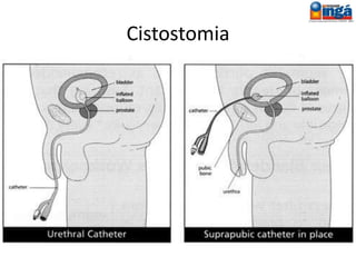 Complicações da colostomia
Estenose por abertura insuficiente da parede
abdominal (refazer o orifício);
Estenose temporária decorrente do edema
da boca cólica (curativos e AINE);
Angulação do cólon exteriorizado por passagem
sinuosa pelos diferentes planos da parede
abdominal (obesos);
 