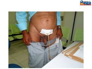 Colostomia
 