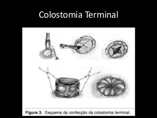 Colostomia Terminal
 