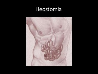 Ileostomia
 