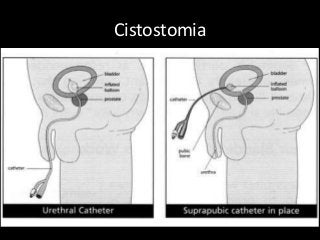 Cistostomia
 