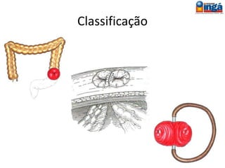 Colostomia
Consiste na exteriorização
do intestino grosso, através
da parede abdominal, para
eliminação de gases ou
fezes.
 
