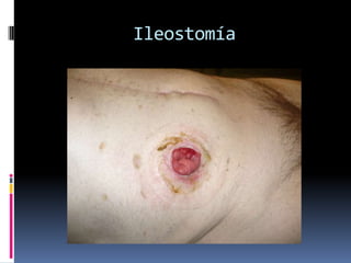 Ileostomía
 