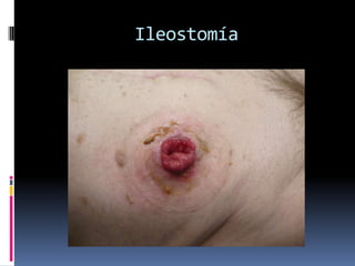 Ileostomía
 