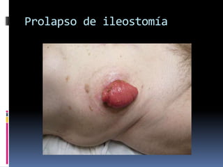 Prolapso de ileostomía
 