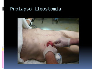 Prolapso ileostomía
 