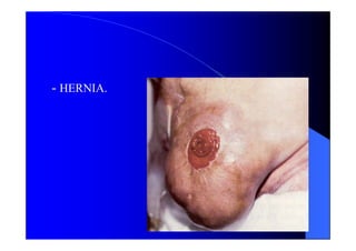 - HERNIA.
 