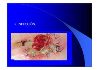 INFECCIÓN.
 