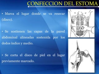 CONFECCION DEL ESTOMA
• Marca el lugar donde se va resecar
(disco).
• Se sostienen las capas de la pared
abdominal alineadas sostenida por los
dedos índice y medio.
• Se corta el disco de piel en el lugar
previamente marcado.
 