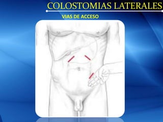 COLOSTOMIAS LATERALES
VIAS DE ACCESO
 