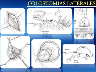 COLOSTOMIAS LATERALES
 