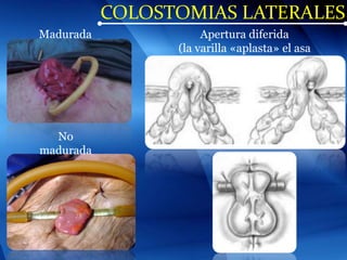 COLOSTOMIAS LATERALES
Madurada
No
madurada
Apertura diferida
(la varilla «aplasta» el asa
distal)
 