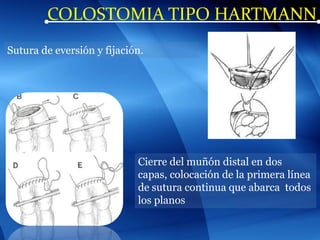 COLOSTOMIA TIPO HARTMANN
Sutura de eversión y fijación.
Cierre del muñón distal en dos
capas, colocación de la primera línea
de sutura continua que abarca todos
los planos
 