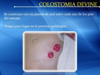 COLOSTOMIA DEVINE
Se construye con un puente de piel entre cada uno de los pies
del estoma.
Ocupa poco lugar en la practica quirúrgica.
 