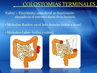 COLOSTOMIAS TERMINALES
•Lahey – Finochietto: cabo distal no funcionante
abocado en el extremo distal de la incisión
• Mickulics-Rankin: en el lado derecho (colon e ileon)
• Mickulics-Lahey (colon y colon)
 