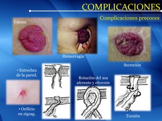 COMPLICACIONES
Edema
Torsión
• Estrechez
de la pared.
• Orificio
en zigzag.
Rotación del asa
aferente y eferente
Complicaciones precoces
Hemorragia
Secreción
 