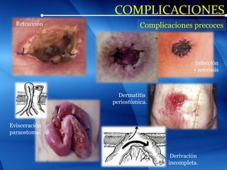 COMPLICACIONES
Dermatitis
periostómica.
Infección
y necrosis
Derivación
incompleta.
Retracción Complicaciones precoces
Evisceración
paraostomal
 