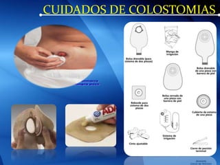 CUIDADOS DE COLOSTOMIAS
 