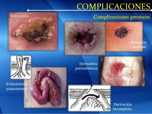 Resultado de imagen para CUIDADO DE COLOSTOMIA
