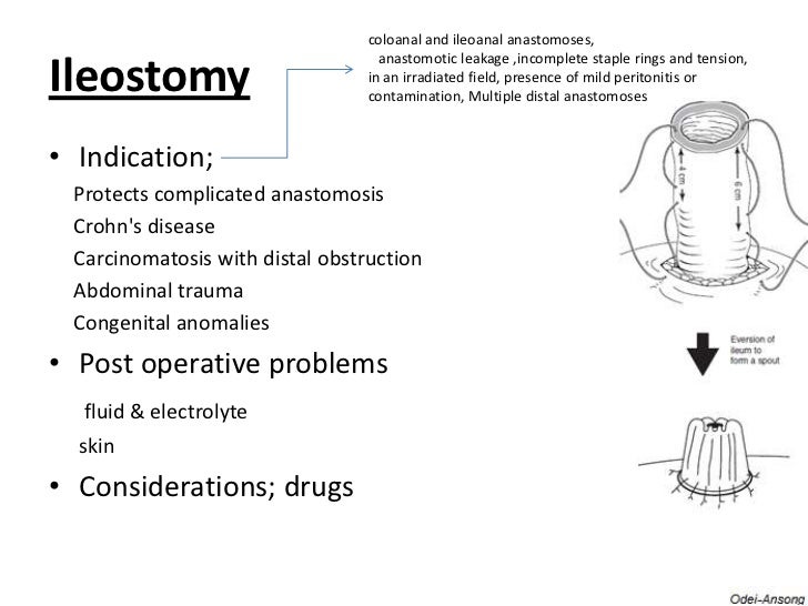 Colostomy