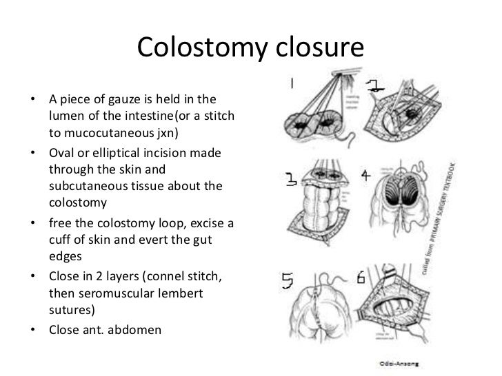 Colostomy