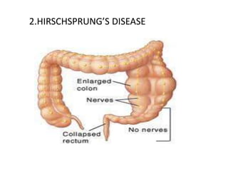 2.HIRSCHSPRUNG’S DISEASE