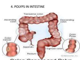 4. POLYPS IN INTESTINE

 