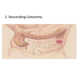 2. Descending Colostomy