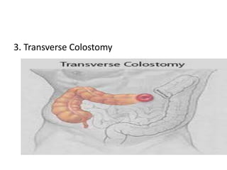 3. Transverse Colostomy