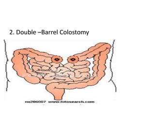 2. Double –Barrel Colostomy