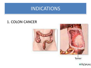 INDICATIONS
1. COLON CANCER