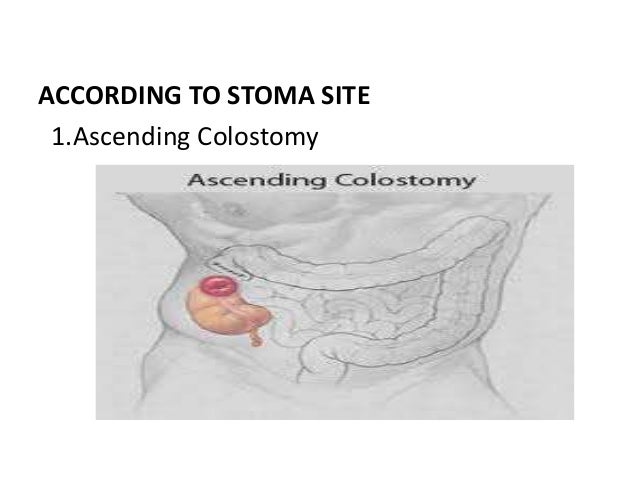colostomy stoma ascending descending