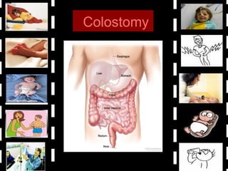 Colostomy
 