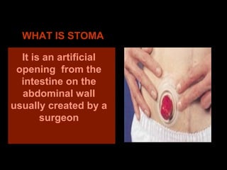 Colostomy | PPT