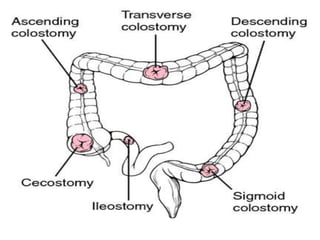 Colostomy | PPTX