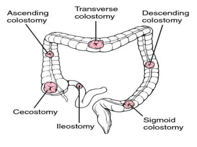 Colostomy | PPTX | Digestive Disorders | Diseases and Conditions