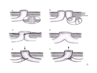 Colostomy | PPTX