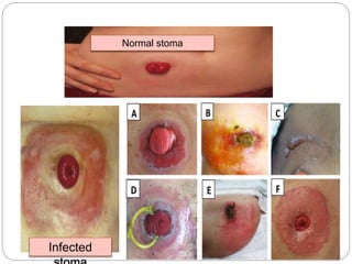 Normal stoma
Infected
 