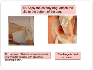12. Apply the ostomy bag. Attach the
clip to the bottom of the bag.
13. Hold palm of hand over ostomy pouch
for 2 minutes to assist with appliance
adhering to skin.
The flange is heat
activated.
 