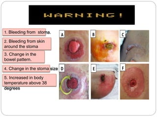 1. Bleeding from stoma.
2. Bleeding from skin
around the stoma
3. Change in the
bowel pattern.
4. Change in the stoma size
5. Increased in body
temperature above 38
degrees
 