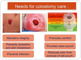 Needs for colostomy care :
Maintains integrity.
Prevents ulceration
and skin breakdown
Prevents infection
Promotes comfort
Provides clean pouch
Reduces odor from
overuse of old pouch.
 