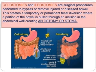 COLOSTOMIES and ILEOSTOMIES are surgical procedures
performed to bypass or remove injured or diseased bowel.
This creates a temporary or permanent fecal diversion where
a portion of the bowel is pulled through an incision in the
abdominal wall creating AN OSTOMY OR STOMA.
 