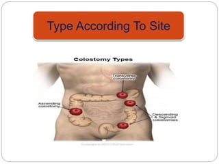 Type According To Site
 